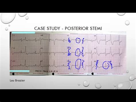 Posterior Myocardial Infarction Ecg