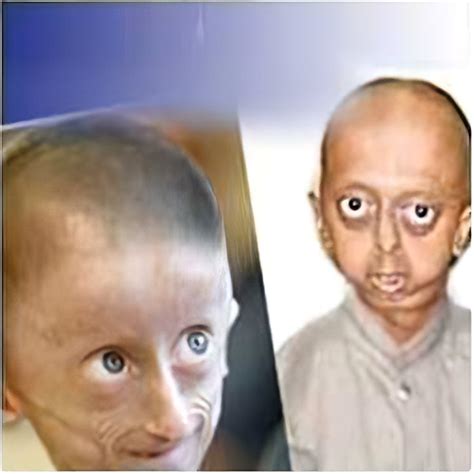 Progeria Therapy