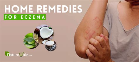 10 Outstanding Natural Home Remedies For Eczema And Itching