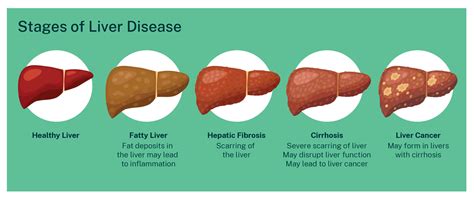 Cirrhosis - Liver Foundation