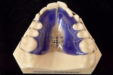 Removable Palatal Expander