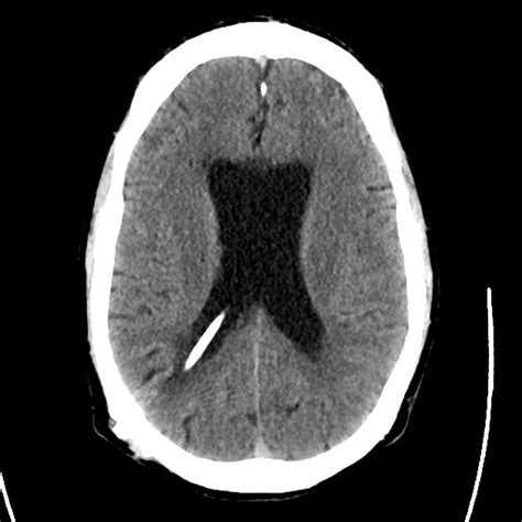 Differential Diagnosis of CSF Shunt Complications