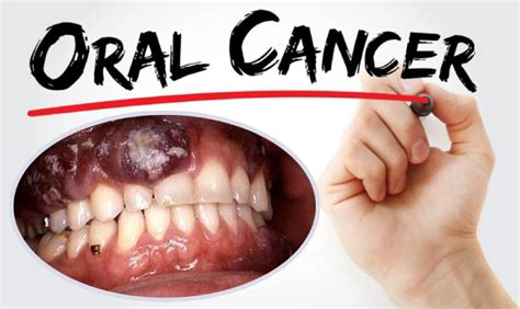 The causes and symptoms of oral cancer?