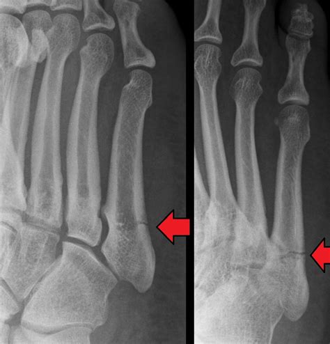 Jones fracture - Wikipedia