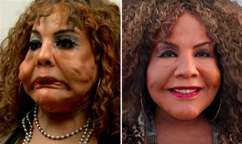 The Most Shocking 'Botched' Plastic Surgery Transformations