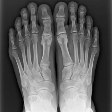 #267 Bulge in metatarsal bone stress fracture on x-ray - DOC