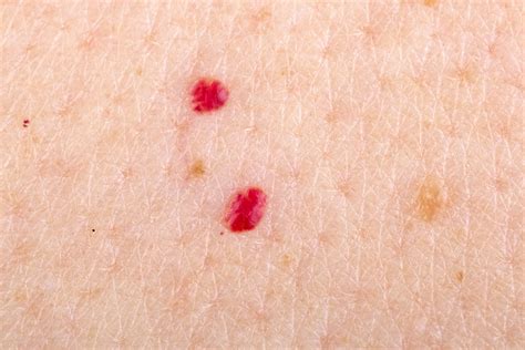 What Those Tiny Red Dots on Your Skin Might Mean » Scary Symptoms