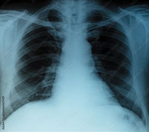 X-RAY scan of the human rib cage. Medical diagnostics. Stock Photo ...