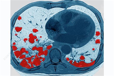 Lung Metastases, CT Scan - Stock Image - C030/6795 - Science Photo Library