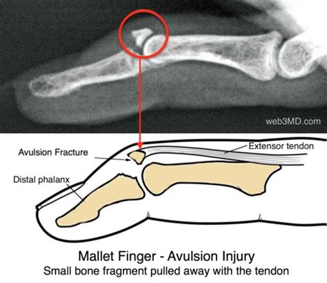 Mallet Finger Fort Worth Hand Therapy Center - OSMI