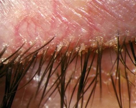 Blepharitis - Causes, Signs and Symptoms, Home Remedies & Treatment