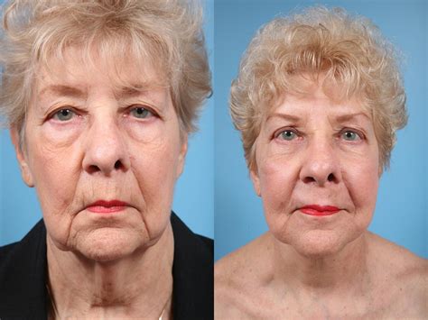 Neck Lift Before & After Photos Patient 67 | Chicago, IL | TLKM Plastic ...