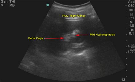 Hydronephrosis | Emory School of Medicine