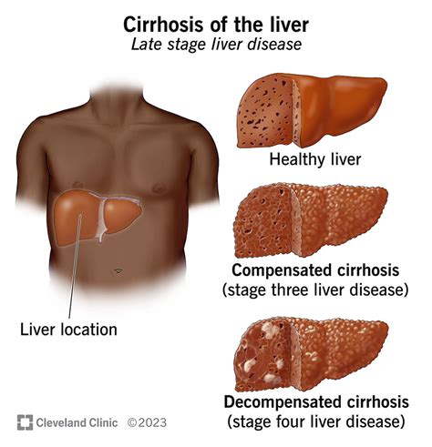 Liver Cirrhosis Stages