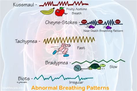 Cheyne Stokes Breathing and Kussmaul Respirations Differences