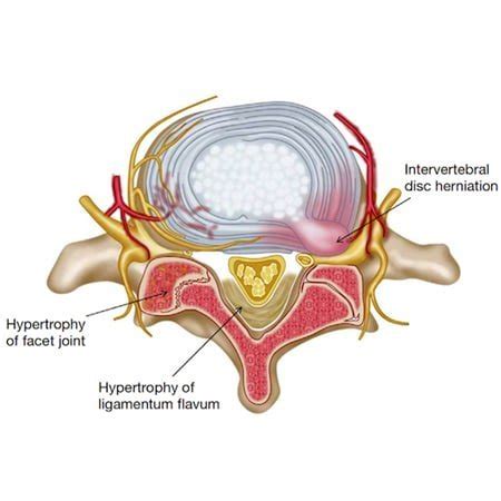 Ligamentum Flavum Hypertrophy | Definition, Cause And Treatment