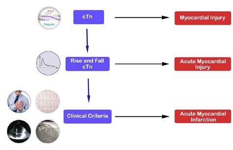 The difference between myocardial injury, acute myocardial injury, and ...