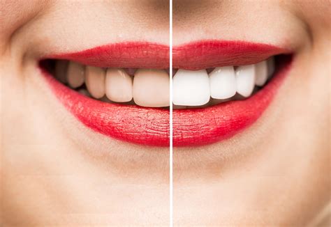 Professional Teeth Whitening from Your Dentist | Marietta, GA