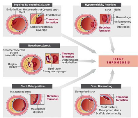 Restenosis, in-stent restenosis causes, symptoms, diagnosis, treatment ...