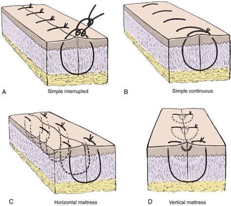 4: Wound Closure Techniques | Pocket Dentistry