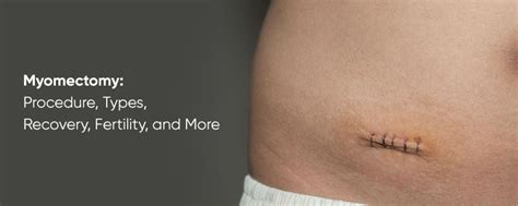 Myomectomy: Procedure, Types, Recovery, Fertility, and More