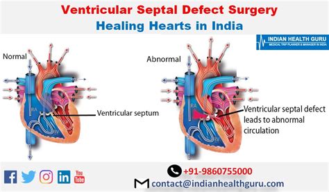 Ventricular Septal Defect Surgery Healing Hearts in India