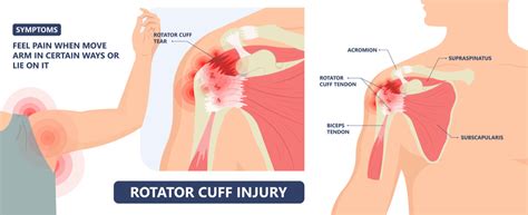 non può inserire ondeggiare rotator cuff injury diagnosis mini diario ...