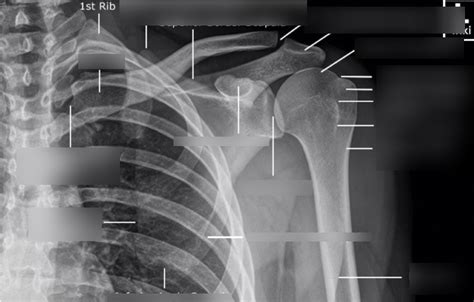 real shoulder xray anatomy Diagram | Quizlet