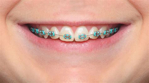 Colored Braces and Bands — Murray Orthodontics