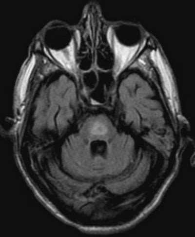 Central Pontine Myelinolysis - Symptoms, Treatment and Prognosis