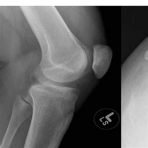 Sunrise, AP and Lateral views of the left knee show no abnormality ...