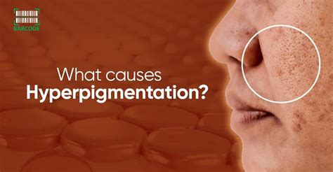 What Causes Hyperpigmentation? 6 UNDERLYING Factors