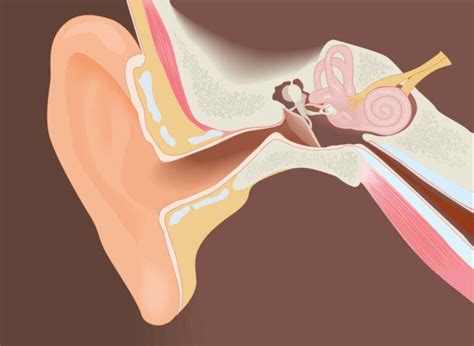 Surgical Removal of Exostoses of the External Auditory Canal