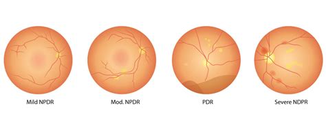 The 4 Stages of Diabetic Retinopathy | Atkinson Eye Care | Diabetic ...