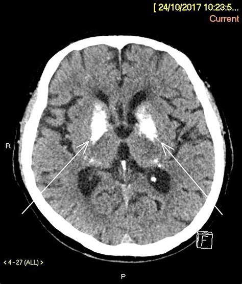 Bilateral Basal Ganglia Calcification: Fahr's Disease | Cureus