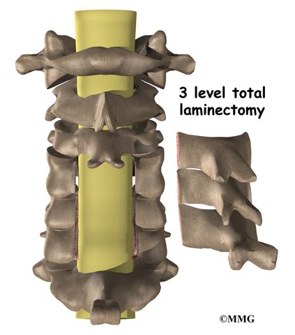 Cervical Laminectomy - Midwest Bone and Joint Institute - Illinois IL