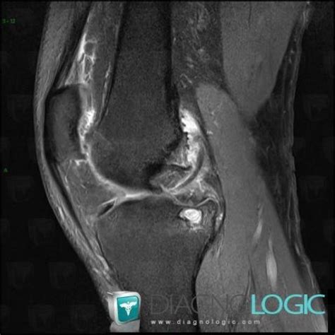 Radiology case : Synovial chondromatosis (X rays ,MRI) - Diagnologic