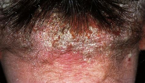 How To Treat Scabs On The Scalp - lifeberrys.com