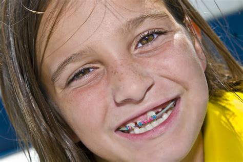 Braces for Kids: What's the Right Age to Start Orthodontia?