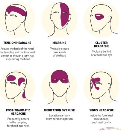 Headache Chart: Types By Symptoms, Location, And Causes