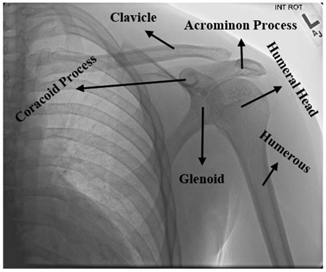 Humerus X Ray Labeled