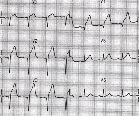 Q Wave • LITFL • ECG Library Basics