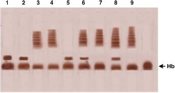 Haptoglobin gene polymorphism in type 2 diabetic patients with and ...