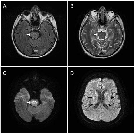 Cureus | Central Pontine Myelinolysis as a Late Complication After ...