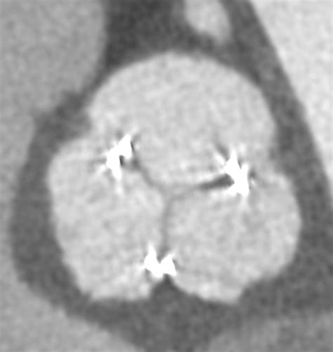 Acute valve malfunction with thrombosed bioprosthetic valve after ...