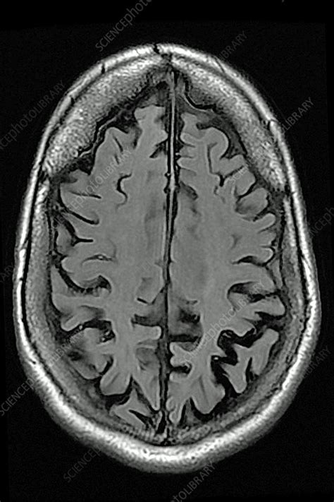 Cerebral atrophy, MRI - Stock Image - C044/8795 - Science Photo Library