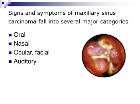 Nasal Sinus Cancer Symptoms