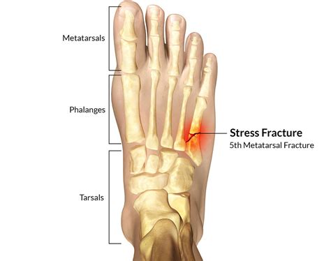 5th Metatarsal Fracture - Motus Physical Therapy