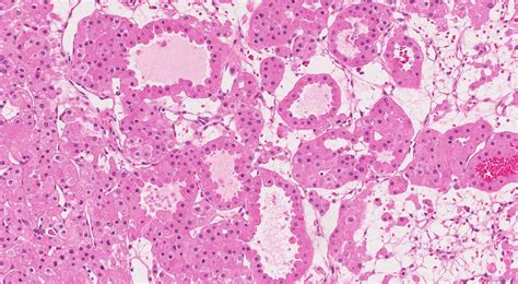 Oncocytoma of the kidney | Ottawa Atlas of Pathology