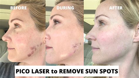 Pico Laser Treatment to Remove Sun Spots Before and After | With Dr ...